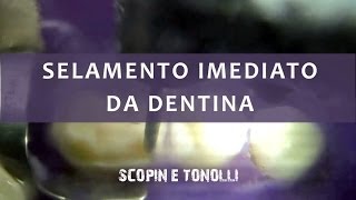 Selamento Imediato da Dentina  Restaurações indiretas [upl. by Longtin]