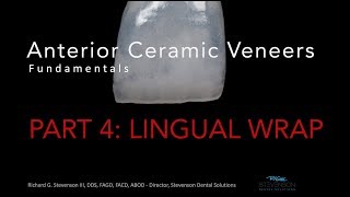 Anterior Ceramic Veneers Part 4 Lingual Wrap [upl. by Vena]