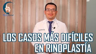 Los casos mas DIFÍCILES en Rinoplastía  PlasticFacial MX [upl. by Yecaw827]