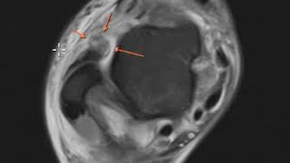 Anterior talofibular ligament tear and posterior tibial tendon tear [upl. by Larred]