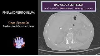 PNEUMOPERITONEUM Case Example – Pneumoperitoneum on CT Perforated Gastric Ulcer [upl. by Ynehteb]