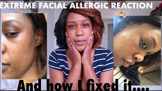 EXTREME FACIAL ALLERGIC REACTION AND HOW I FIXED IT  STORYTIME [upl. by Carmella930]