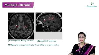 Multiple Sclerosis Part 2 Hindi Internal Medicine [upl. by Iegres414]