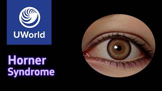 Horner Syndrome amp Lateral Medullary Wallenberg Syndrome  extra high yield USMLE UWorld Question [upl. by Tiny]