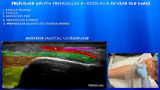 Ultrasound Guided Cortisone Injection for Presumed Gouty Prepatellar Bursitis in a 66 Year Old Male [upl. by Sailesh938]