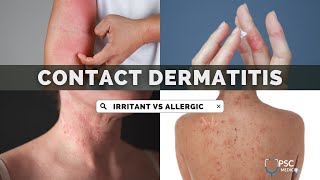 Irritant Contact Dermatitis vs Allergic Contact Dermatitis  Dermatology  UPSC MEDICO [upl. by Dimitris]