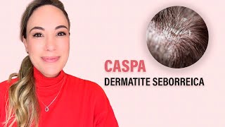 Dermatite Seborreica  a tão temida CASPA [upl. by Joon]