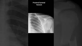 Proximal humeral fracture xrayshoulder [upl. by Iramohs93]