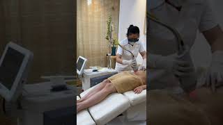 Renas  Fractional Erbium Glass Laser for Stretch Marks Treatment [upl. by Martel740]