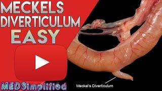 Meckels Diverticulum Made Easy [upl. by Sweeney]