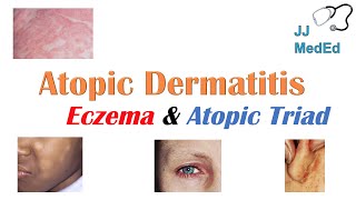 Eczema Atopic Dermatitis  Atopic Triad Triggers Who gets it Why does it happen amp Treatment [upl. by Anahsor669]