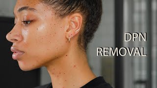 Dermatosis Papulosa Nigra DPN Removal [upl. by Lladnarc]