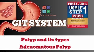 USMLE Step1 Polyp and its types Adenomatous Polyps from first aid step 1USMLEUrduHindi [upl. by Yehus]