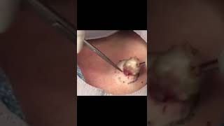 Open Wide Dr Pimple Popper POPS amp Pulls MASSIVE… shorts [upl. by Atineb555]