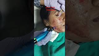 Acne scars treatmentfashion laserskincare laserbeauty acnescars acnetreatment beauty facial [upl. by Ilatan923]