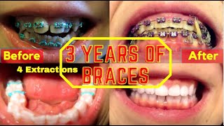 Braces in 1 Minute  Time Lapse  4 Teeth EXTRACTIONS amp SEVERE Overbite [upl. by Durr]