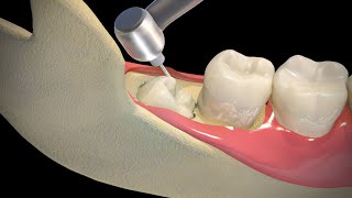 Wisdom Teeth Extraction  Step by step [upl. by Andrien]