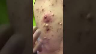 Blackheads and milia big cystic acne blackheads extraction  Newest pimple popping this week [upl. by Reeve]