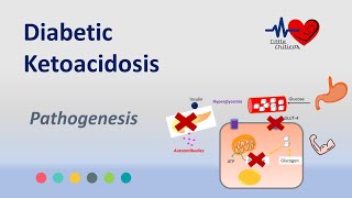 What is Diabetic Ketoacidosis   Pathogenesis and Diagnosis of DKA [upl. by Briney]