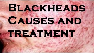 Blackheads Causes and treatment [upl. by Eenal388]