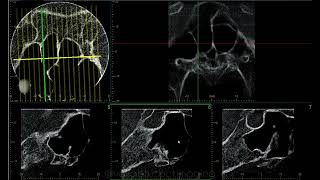 SPHENOID SINUS CASE REPORT [upl. by Aivila]