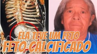 Mulher de 81 anos carregava um feto Calcificado na barriga [upl. by Kciredohr]