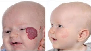 Current Management and Treatment of Infantil Hemangiomas [upl. by Easton138]