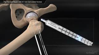 Hip Fracture Repair with Cannulated Screws [upl. by Neved]