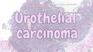 Urothelial carcinoma  urinary system pathology [upl. by Lilah782]