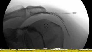 Inadvertent Deltoid Muscle Injection under Fluoroscopy  ThePainSourcecom [upl. by Vizzone658]