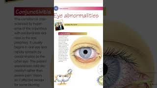 conjectivitious Eye inflammation conjectivitious Eye inflammation youtubeshorts abubakarmedplus [upl. by Viola]