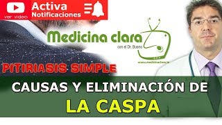 Caspa cómo eliminar la caspa Mejor tratamiento médico para la pitiriasis simple  Medicina Clara [upl. by Iaras]