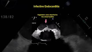 Infective Endocarditis [upl. by Jit314]