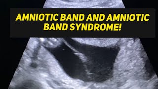 Amniotic band syndrome  learn ultrasound  ultrasound radiology [upl. by Adnilab]