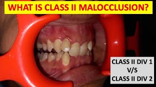 WHAT IS CLASS 2 MALOCCLUSION CLASS 2 DIV1 AND DIV2  ORTHODONTICS  dentalcafe4331 [upl. by Michelsen]