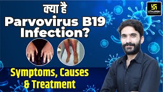 क्या है Parvovirus B19 Infection🦠 Symptoms Causes amp Treatment [upl. by Erund]