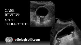 Ultrasound of Acute Cholecystitis [upl. by Karoly296]