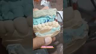 Zirconia bridge viralvideozirconiashortvideo [upl. by Hubert323]