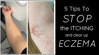 HEALING ECZEMA  5 Things I Do Each Day To STOP THE ITCH [upl. by Atinyl]