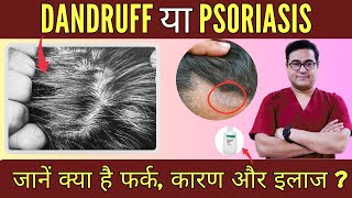 Dandruff Vs Scalp Psoriasis  डैंड्रफ Vs सोरायसिस  Health Mantra With Dr Vikram [upl. by Aitropal16]