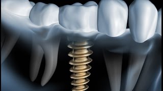 worauf kommt es an bei einem Zahnimplantat [upl. by Estelle]