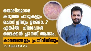 Black itchy spots on skin Could be lichen planus  Causes and management  Dr ABHIRAM V K [upl. by Ruffina]