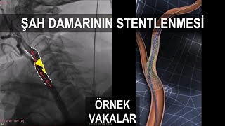 Şah Damarındaki Karotis Darlığın Stent ile Ameliyatsız Açılması Örnek Vakalar [upl. by Itsur]