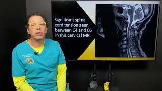 Internal tremors whole body vibrations amp the connection to neck instability amp spinal cord tension [upl. by Sefton]