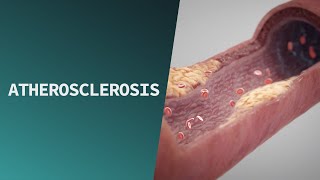 Atherosclerosis  Pathologies [upl. by Adnileb]