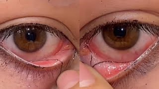 Removing Long Eye Mucus Strings [upl. by Rebak]