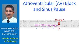 Sinoatrial SA and Atrioventricular AV blocks [upl. by Winonah]