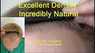 FUE Hair Transplant Results 2329 grafts before and after [upl. by Ardnuassak23]