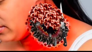 Neck infection cleaning asmr animation relaxing sounds video [upl. by Niowtna]