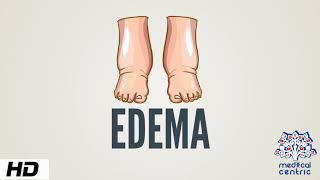 Edema Causes Signs and Symptoms Diagnosis and Treatment [upl. by Elexa]